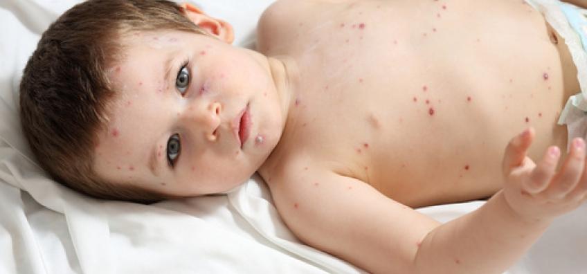 bébé contaminé varicelle